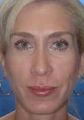 Rhinoplasty