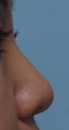 Non Surgical Rhinoplasty