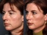 Rhinoplasty