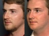 Rhinoplasty