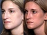 Rhinoplasty