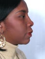 Rhinoplasty