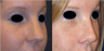 Rhinoplasty