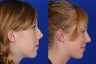 Open Rhinoplasty
