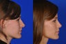 Open Rhinoplasty