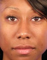 Rhinoplasty