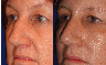 Rhinoplasty, closed technique with osteotomies