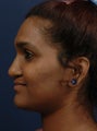 Rhinoplasty for cleft lip nasal deformity