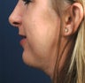 Rhinoplasty and Chin Implant