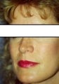 Rhinoplasty