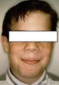 Repair congential defect with open Septorhinoplasty