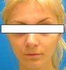 Rhinoplasty to correct dorsal hump and drooping nasal tip in 15 year old girl