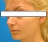 Rhinoplasty to correct dorsal hump and drooping nasal tip in 15 year old girl