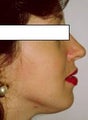 Septorhinoplasty to correct breathing difficulty and cosmetic dorsal hump deformity