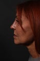 Rhinoplasty