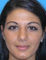Reduction Rhinoplasty