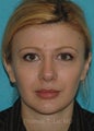 Rhinoplasty, minor neck liposuction