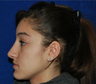 Rhinoplasty