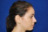 Rhinoplasty