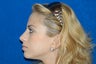 Rhinoplasty