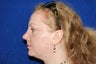 Rhinoplasty
