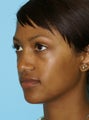 Nose Reshaping