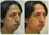 Rhinoplasty