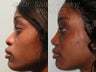African American Rhinoplasty