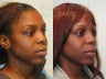 African American Rhinoplasty