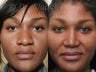 African American Rhinoplasty