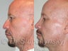 Ethnic Rhinoplasty