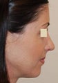 Rhinoplasty and IPL PhotoFacial, profile view