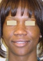 African American Rhinoplasty