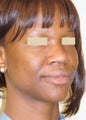 African American Rhinoplasty