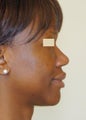 African-American Rhinoplasty