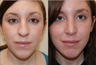 Rhinoplasty