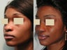 African American Rhinoplasty