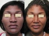 African American Rhinoplasty