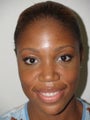 Primary rhinoplasty
