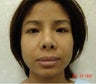 Rhinoplasty