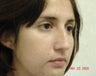 Rhinoplasty