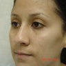 Rhinoplasty