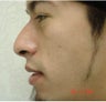 Rhinoplasty