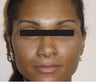 Rhinoplasty