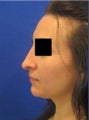 Rhinoplasty