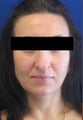 Rhinoplasty