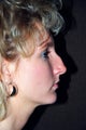 Rhinoplasty (nose job)