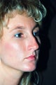 Rhinoplasty (nose job)