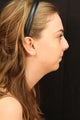 Rhinoplasty with chin augmentation