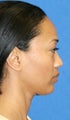 rhinoplasty